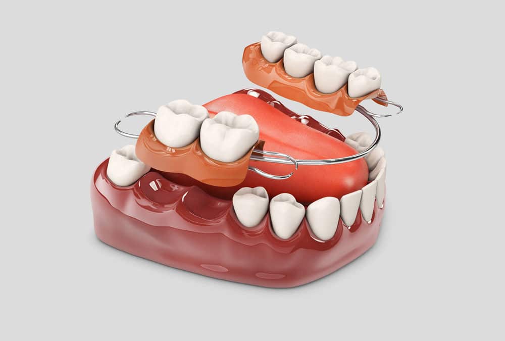 La Revolución de la Odontología: Implantes Dentales Sin Tornillos