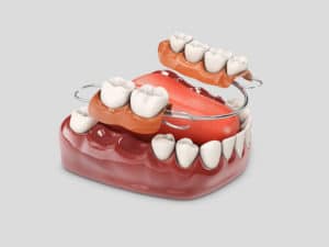 Implantes dentales sin tornillos