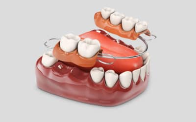 La Revolución de la Odontología: Implantes Dentales Sin Tornillos