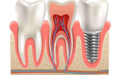 Rechazo a los Implantes Dentales: Causas, Prevención y Soluciones
