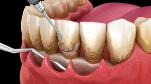 Raspado dental