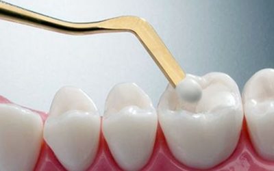 La Obturación Dental y la Obturación con Composite: Soluciones Avanzadas para la Salud Dental