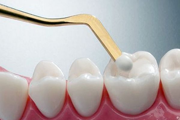 La Obturación Dental y la Obturación con Composite: Soluciones Avanzadas para la Salud Dental