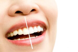 Tipos de blanqueamiento dental en Córdoba