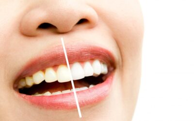 Tipos de blanqueamiento dental: en clínica, en casa y combinado