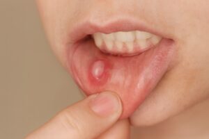 Mucoceles qué son, causas y tratamiento