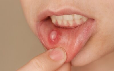 Mucoceles: qué son, por qué aparecen y cómo tratarlos